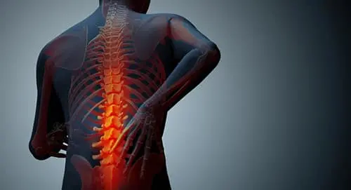 Spondylitis jpg