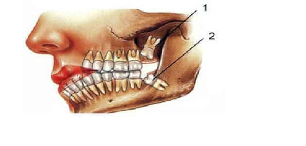اعراض ضرس العقل المدفون السفلي وكيفيه علاجه قبل الخلع