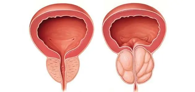الفرق بين سرطان البروستاتا وتضخم البروستاتا 1 jpg