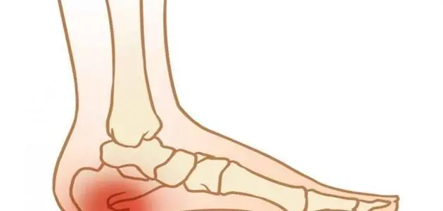 طرق علاج شوكة القدم jpg