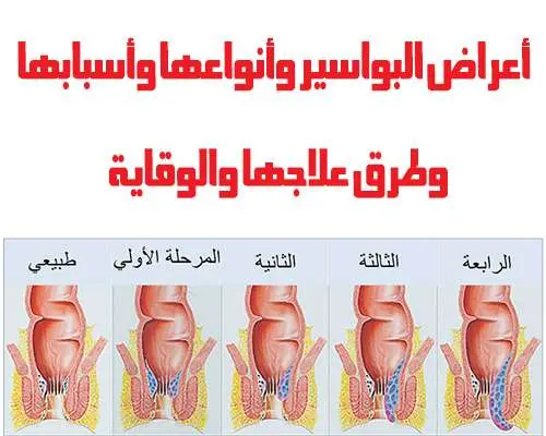 علاج البواسير jpg