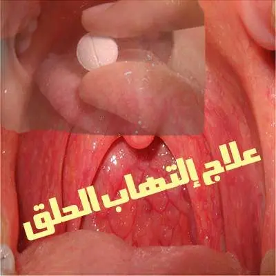 علاج التهاب الحلق jpg