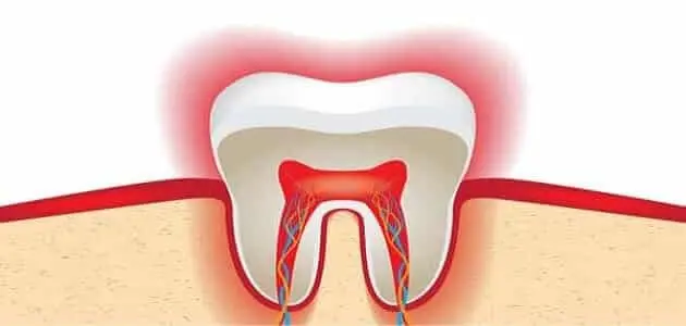 علاج التهاب عصب الضرس وانتفاخ الخد jpg